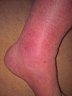 My left ankle showing the swelling and discolouration